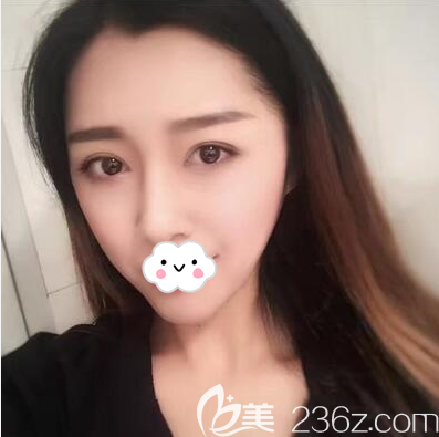 成都銅雀臺徐墩雙眼皮術(shù)后半個月恢復(fù)圖