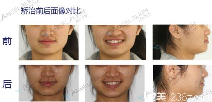 深圳拜爾口腔成人牙齒擁擠矯正后臉型變化圖 深圳拜爾口腔成人牙齒擁擠矯正后臉型變化圖