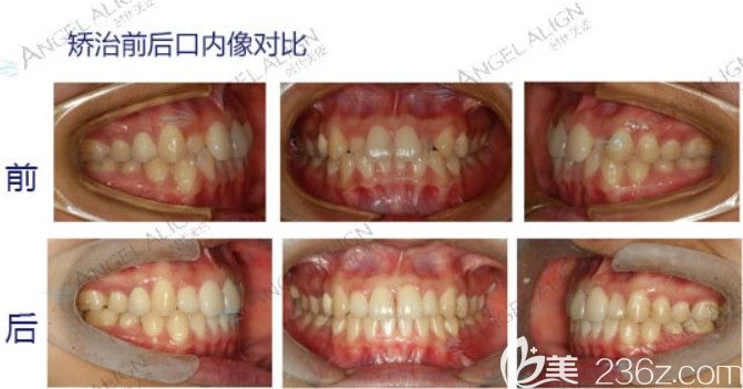 牙齒擁擠做完牙齒矯正后口內(nèi)對比效果 牙齒擁擠做完牙齒矯正后口內(nèi)對比效果