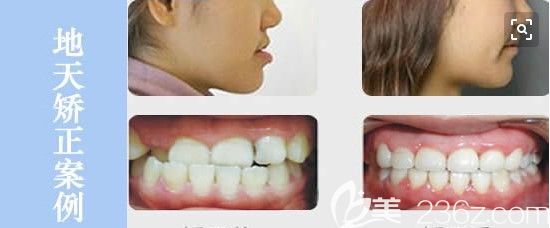 深圳拜爾口腔青少年地包天矯正臉型變化及前后對比照 深圳拜爾口腔青少年地包天矯正臉型變化及前后對比照