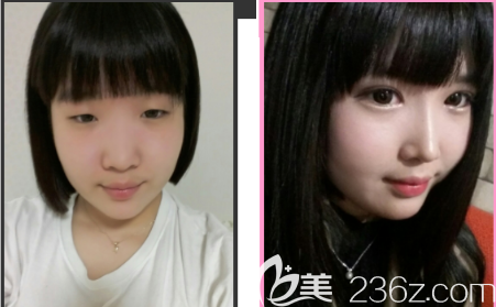 韓國(guó)卡拉美爾caramel整形外科姜宗和雙眼皮+開(kāi)眼角+上瞼下垂矯正案例