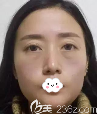 做面部脂肪填充術(shù)前素顏照片 做面部脂肪填充術(shù)前素顏照片