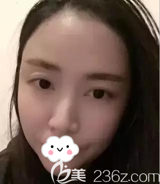 <!--<i data=20240703-sp></i>-->面填術(shù)后即刻照片 <!--<i data=20240703-sp></i>-->面填術(shù)后即刻照片