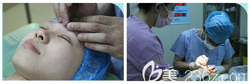 北京藝星美杜莎美眼手術(shù)過程示意圖