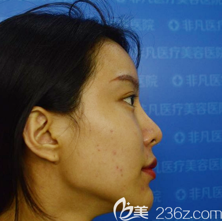 深圳非凡醫(yī)療美容醫(yī)院梅夠明術(shù)前照片1