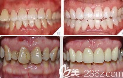 醫(yī)院口腔科黃菁牙齒美白案例
