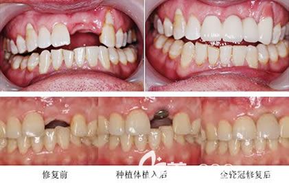 黃菁種植牙案例