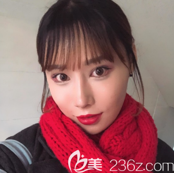 韓國POP整形醫(yī)院鼻綜合隆鼻術后2周恢復效果圖 韓國POP整形醫(yī)院鼻綜合隆鼻術后2周恢復效果圖