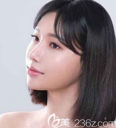 花3W多價格找韓國鼻子修復口碑好的韓國首爾POP整形醫(yī)院做鼻綜合隆鼻恢復過程圖