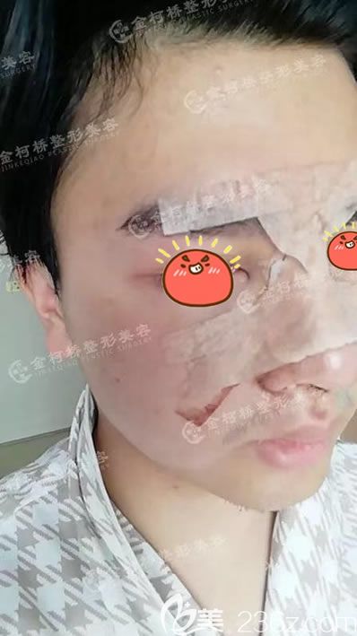 <!--<i data=20240703-sp></i>-->陳樹(shù)科隆鼻案例即刻效果 <!--<i data=20240703-sp></i>-->陳樹(shù)科隆鼻案例即刻效果