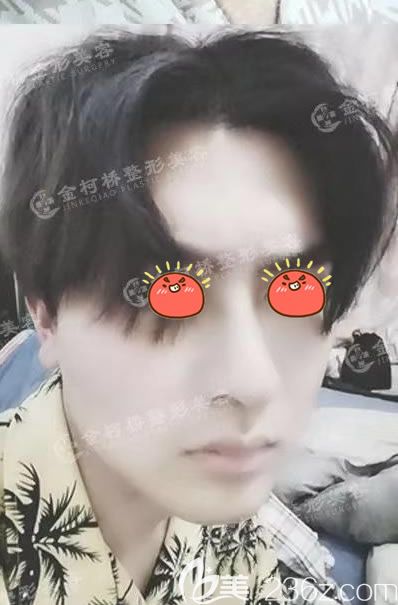 <!--<i data=20240703-sp></i>-->醫(yī)院自體軟骨隆鼻案例 <!--<i data=20240703-sp></i>-->醫(yī)院自體軟骨隆鼻案例