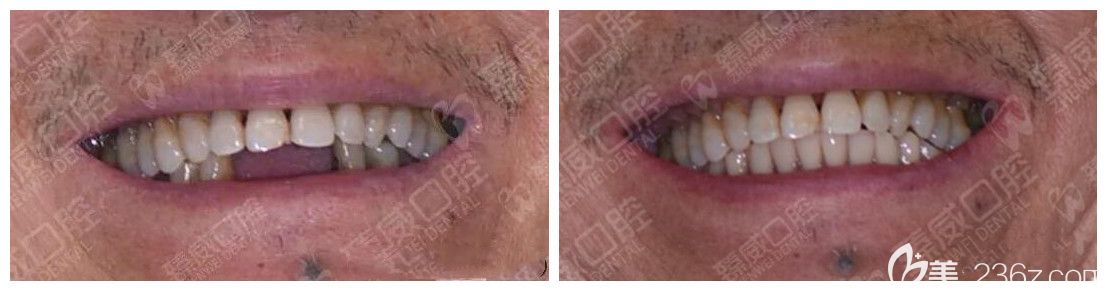 案例效果來(lái)證明<!--<i data=20240703-sp></i>-->臻威口腔好不好 案例效果來(lái)證明<!--<i data=20240703-sp></i>-->臻威口腔好不好