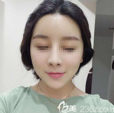 韓國拉菲安做顴骨縮小術(shù)+長曲線下頜角手術(shù)后4個月改善了我的顴骨左右不對稱