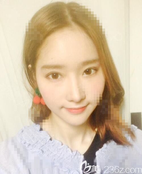 韓國秀美顏整形醫(yī)院(TOPFACE)案例 韓國秀美顏整形醫(yī)院(TOPFACE)案例