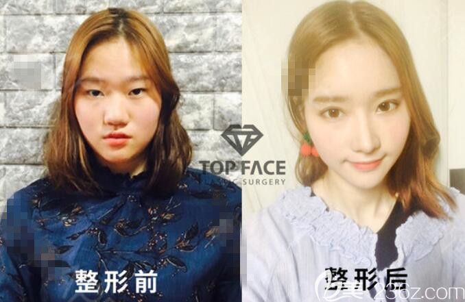 韓國秀美顏整形醫(yī)院(TOPFACE)怎么樣 韓國秀美顏整形醫(yī)院(TOPFACE)怎么樣