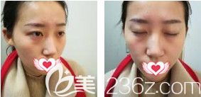 在石家莊天宏做雙眼皮術前是無神單眼皮 在石家莊天宏做雙眼皮術前是無神單眼皮