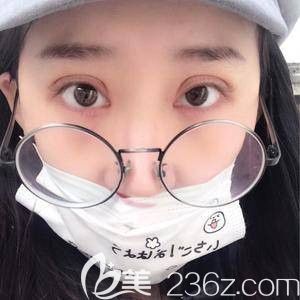 天宏整形主任孫蘇寧為我做雙眼皮術后5天微腫 天宏整形主任孫蘇寧為我做雙眼皮術后5天微腫