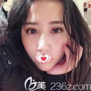 孫蘇寧主任為我做雙眼皮術后12天慢慢消腫 孫蘇寧主任為我做雙眼皮術后12天慢慢消腫