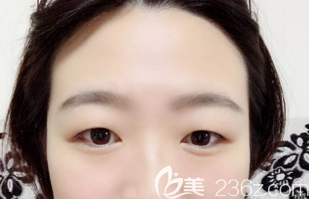 雙眼皮術(shù)前照片 雙眼皮術(shù)前照片