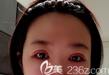 雙眼皮術(shù)后一周 雙眼皮術(shù)后一周