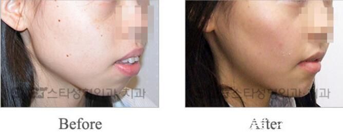韓國(guó)明星star整形外科突嘴矯正案例