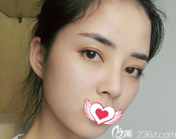 玻尿酸豐臉頰術(shù)后第7天臉型有了明顯的變化