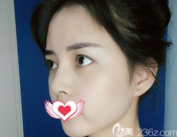 玻尿酸填充臉頰20天皮膚光滑細膩