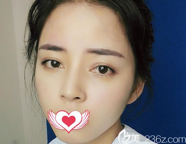  臉頰凹陷找美萊李大鐵做了玻尿酸填充兩側臉頰后，效果簡直太美了