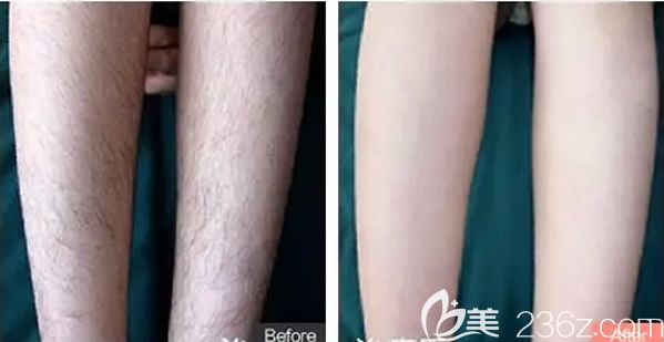 呼市華醫(yī)脫毛效果怎么樣