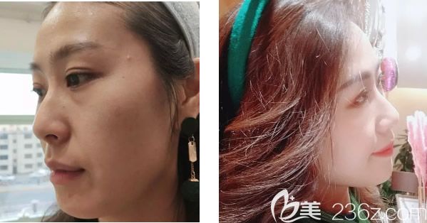 華醫(yī)員工注射瑞恩詩(shī)15天效果怎么樣