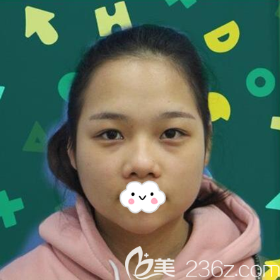 做綜合隆鼻手術(shù)前的照片 做綜合隆鼻手術(shù)前的照片