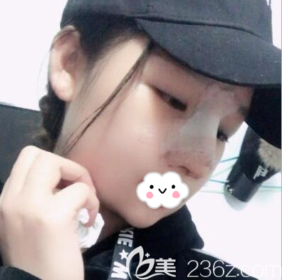 在內(nèi)江達(dá)芬奇作為鼻綜合術(shù)后即刻照片 在內(nèi)江達(dá)芬奇作為鼻綜合術(shù)后即刻照片