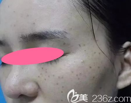 沒去景德鎮(zhèn)圣嘉麗整形做皮秒激光祛斑前的照片 沒去景德鎮(zhèn)圣嘉麗整形做皮秒激光祛斑前的照片