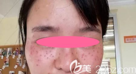 去景德鎮(zhèn)圣嘉麗整形做皮秒激光祛斑治療后即刻效果圖 去景德鎮(zhèn)圣嘉麗整形做皮秒激光祛斑治療后即刻效果圖