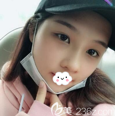 自體軟骨綜合隆鼻拆線后效果圖 自體軟骨綜合隆鼻拆線后效果圖