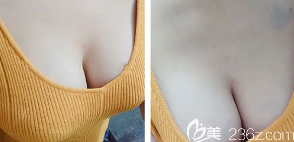 假體隆胸20天手感摸著有點硬