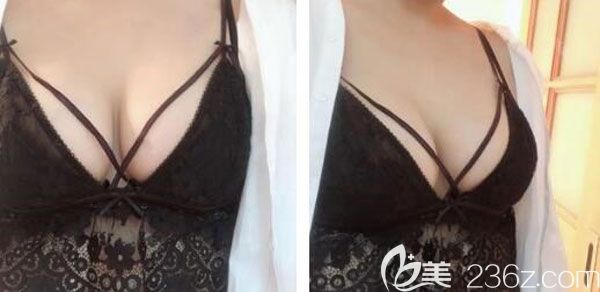 產(chǎn)后胸部松弛下垂找美萊做曼托假體隆胸手術(shù)后，改變的不止一點點哦！