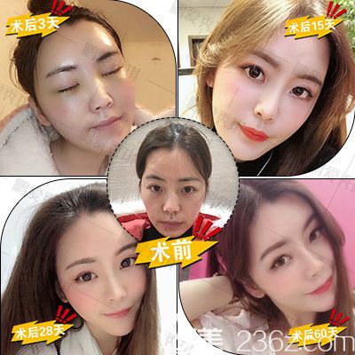 深圳鵬愛秀琪譚濤醫(yī)生自體脂肪面部填充全臉案例 深圳鵬愛秀琪譚濤醫(yī)生自體脂肪面部填充全臉案例