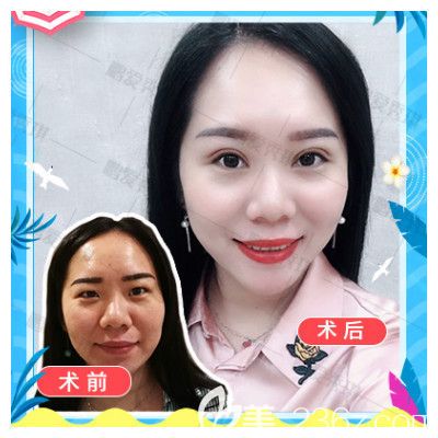 深圳鵬愛秀琪譚濤醫(yī)生雙眼皮案例 深圳鵬愛秀琪譚濤醫(yī)生雙眼皮案例