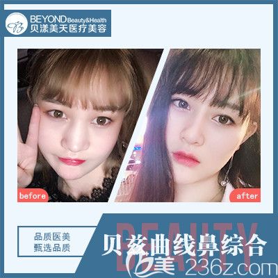 深圳貝漾美天董磊醫(yī)生合隆鼻案例 深圳貝漾美天董磊醫(yī)生合隆鼻案例