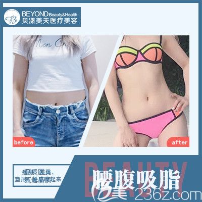 深圳貝漾美天董磊腰腹部吸脂案 深圳貝漾美天董磊腰腹部吸脂案