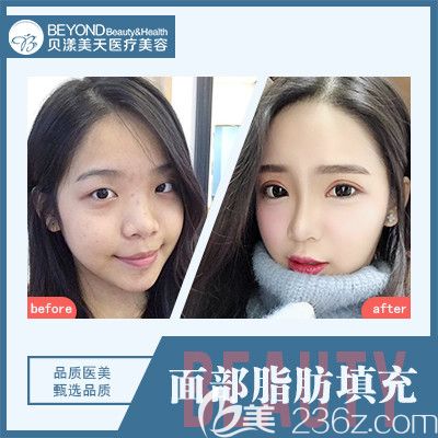 深圳貝漾美天董磊醫(yī)生自體脂肪面部填充案例 深圳貝漾美天董磊醫(yī)生自體脂肪面部填充案例