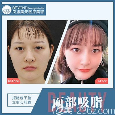深圳貝漾美天董磊面部吸脂案例 深圳貝漾美天董磊面部吸脂案例
