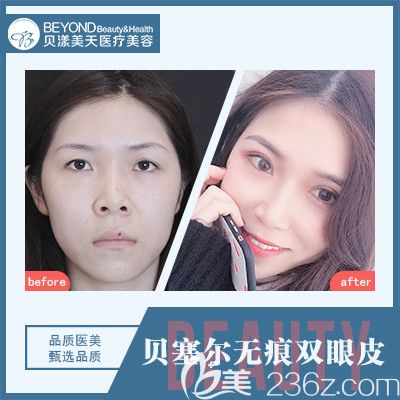 深圳貝漾美天曹思佳院長雙眼皮案例 深圳貝漾美天曹思佳院長雙眼皮案例