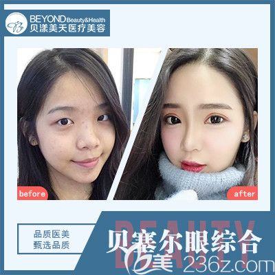 深圳貝漾美天曹思佳院長貝塞爾眼綜合案例 深圳貝漾美天曹思佳院長貝塞爾眼綜合案例