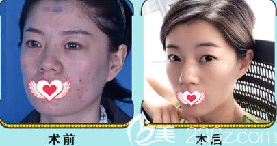 邯鄲京美注射瘦臉案例