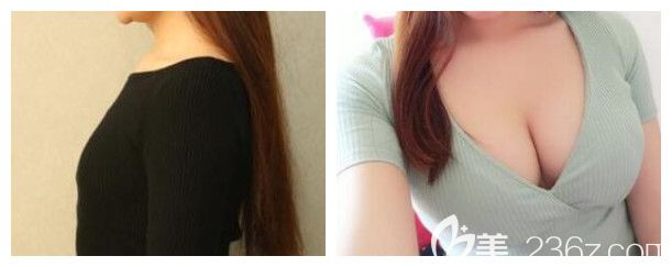 南寧夢(mèng)想整形自體脂肪隆胸案例 南寧夢(mèng)想整形自體脂肪隆胸案例