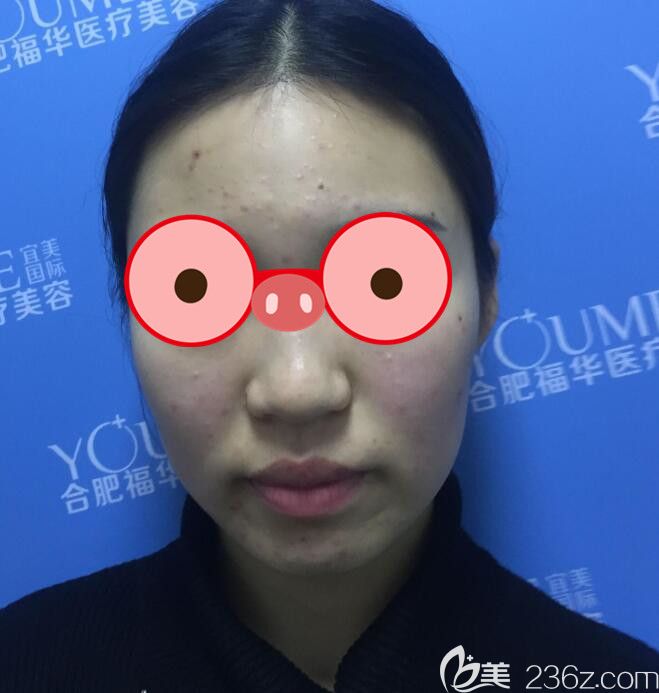 不清楚合肥福華整形怎么樣，可以看院長給我做的面部吸脂21天恢復(fù)過程圖
