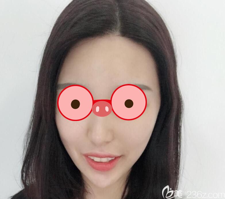 <!--<i data=20240703-sp></i>-->做面部吸脂第7天恢復(fù)情況 <!--<i data=20240703-sp></i>-->做面部吸脂第7天恢復(fù)情況