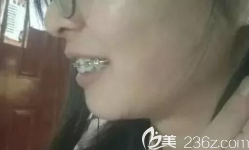 <!--<i data=20240703-sp></i>-->臻威口腔齙牙戴鋼絲牙套矯正250天